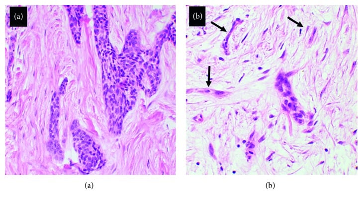Histology showing basaloid, squamoid, tubular and single-cell epithelial patterns in adamantinoma
