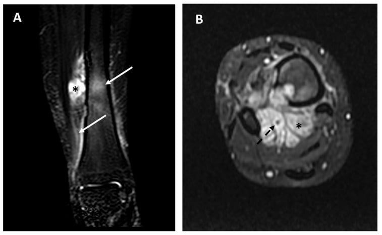 Coronal and axial MRI showing distal tibial adamantinoma with extraosseous extension, oedema and vascular encasement