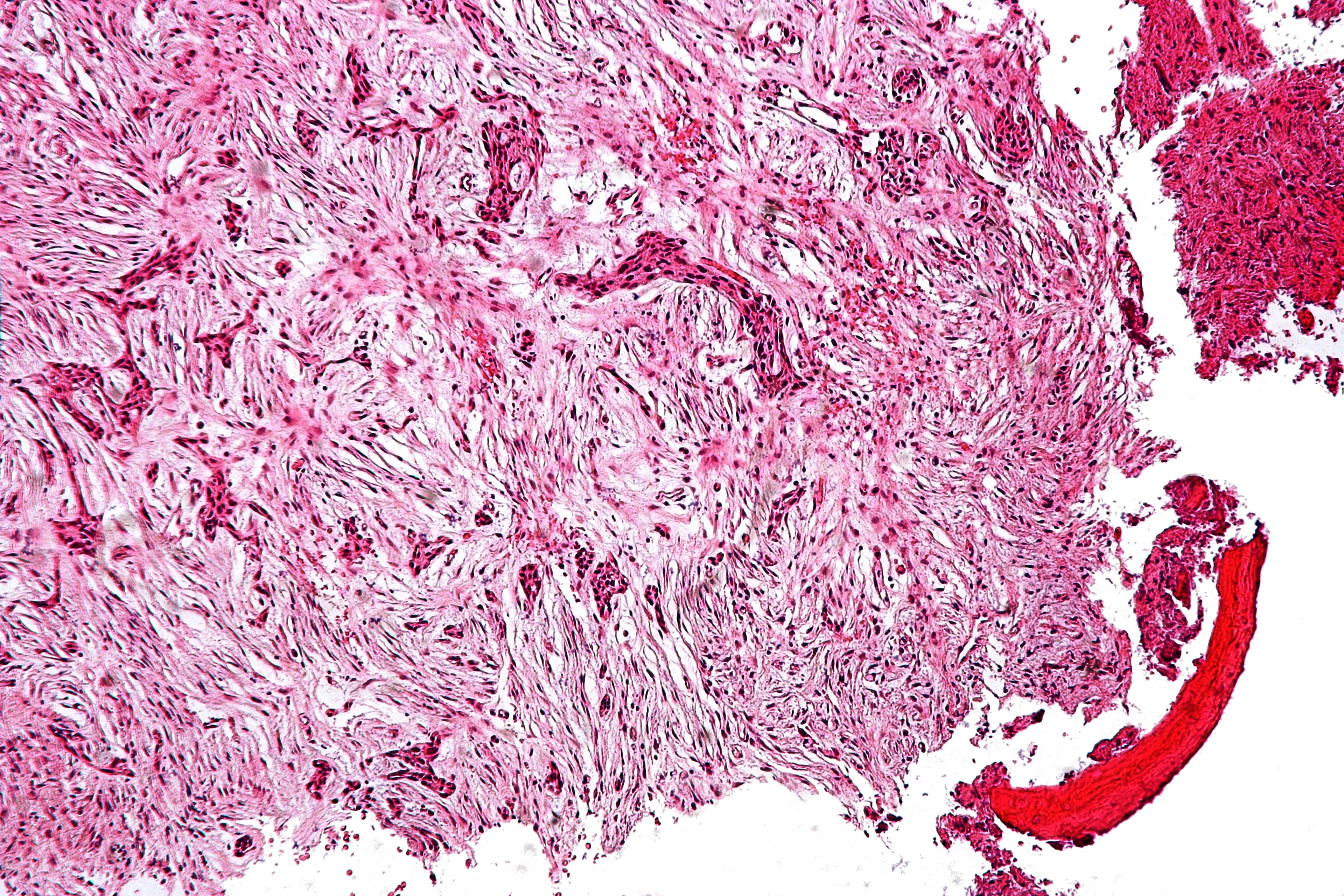 Intermediate-power H&E histology of adamantinoma, predominantly showing bland spindle cells in a loose fibrous stroma.
