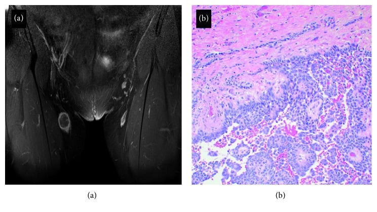 Contrast MRI and histology of an inguinal lymph-node metastasis from tibial adamantinoma