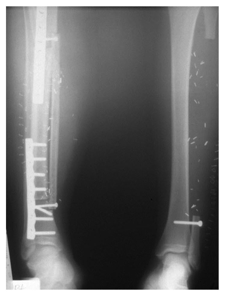 Postoperative radiographs after tibial adamantinoma resection reconstructed with structural allograft and vascularised fibula