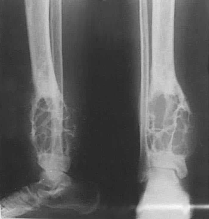 AP and lateral radiographs of the distal tibia showing a multiloculated, expansile lytic 'soap-bubble' lesion typical of adamantinoma.