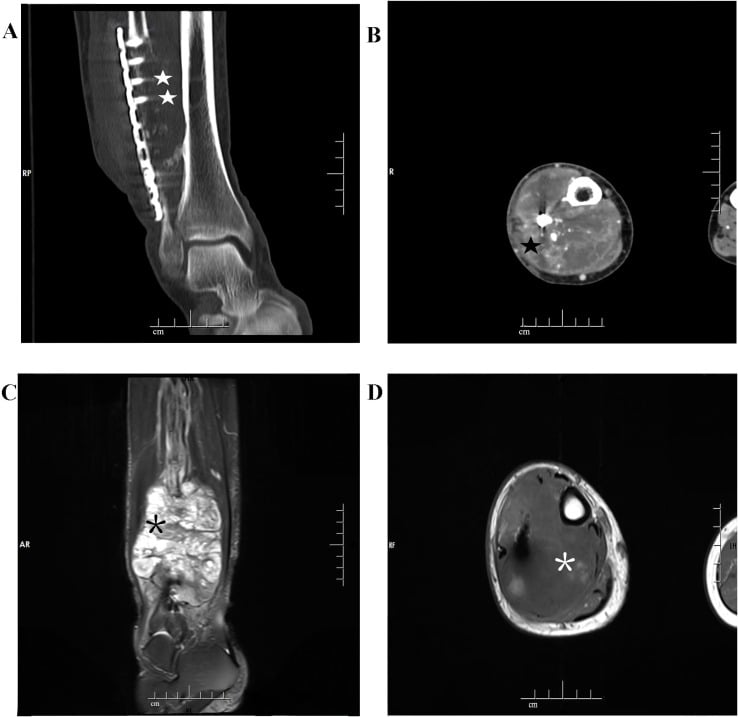 CT and MRI of destructive dedifferentiated adamantinoma of the distal fibula around previous fixation