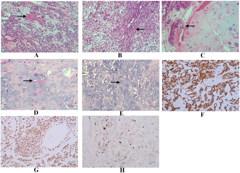 Histological and immunohistochemical panel showing classic and dedifferentiated components of adamantinoma