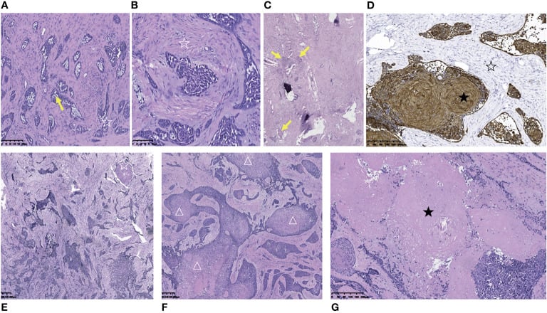 Histology and immunohistochemistry of metastatic adamantinoma showing epithelial islands in spindle-cell stroma