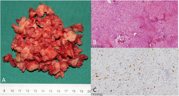 Curettage specimen, histology and cytokeratin immunostain of osteofibrous dysplasia-like adamantinoma