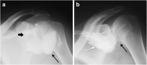 Two-panel shoulder arthrogram comparing normal recess filling with reduced filling in adhesive capsulitis