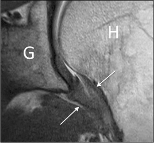 Coronal oblique MRI of the shoulder with arrows on a thickened inferior capsule at the axillary pouch