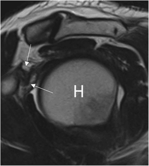 Sagittal oblique T2 MRI of the shoulder with arrows on a thickened coracohumeral ligament in the rotator interval