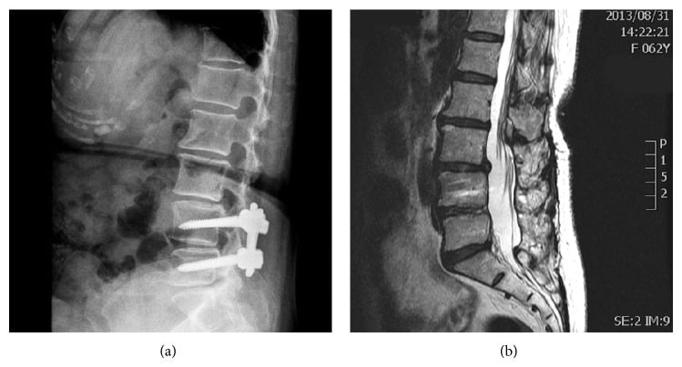 Lateral lumbar radiograph and sagittal T2 MRI showing prior L4-5 fixation with adjacent L3-4 degeneration.