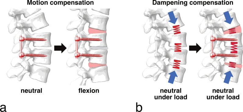Schematic showing motion compensation and dampening compensation at segments adjacent to a spinal fusion.