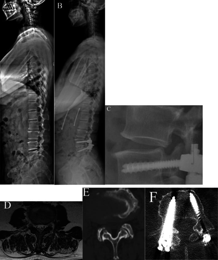 Follow-up lumbar radiographs and MRI showing L3 retrolisthesis after L4-5 TLIF.