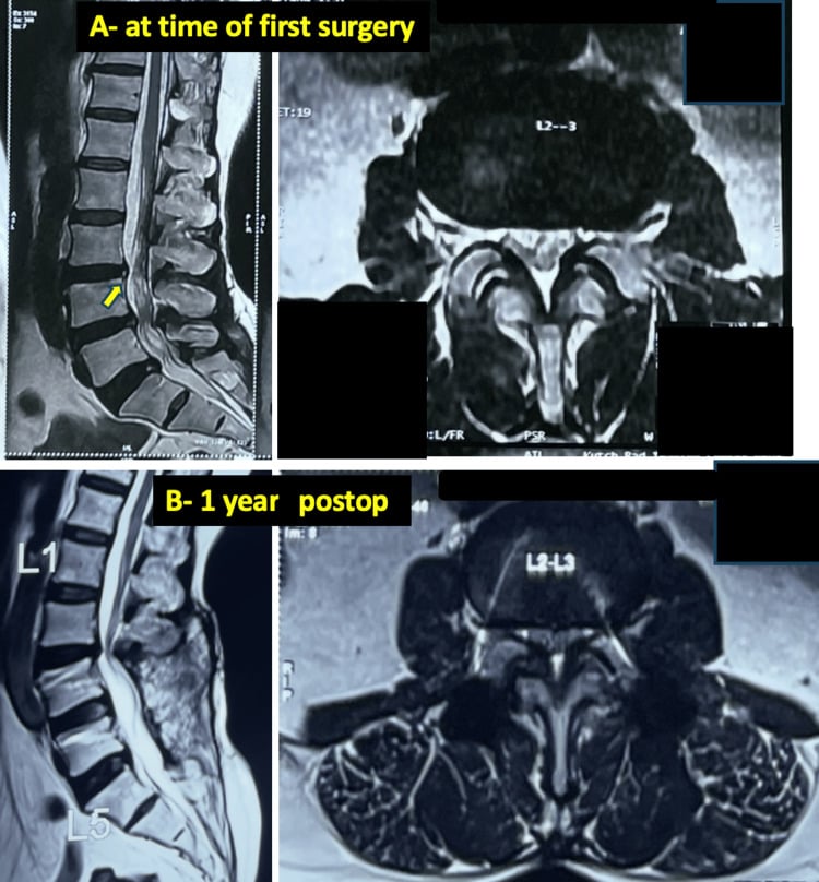Serial sagittal and axial T2 MRI showing progression of adjacent-level stenosis after lumbar fusion.