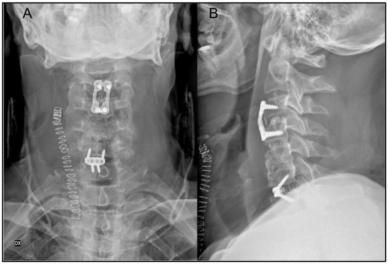 Postoperative AP and lateral cervical radiographs showing extension of a prior cervical fusion to adjacent levels.