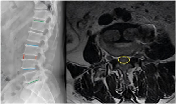 Lateral lumbar radiograph and axial MRI with disc-height, lordosis and canal-region measurements.