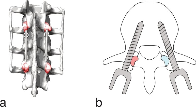 Posterior lumbar schematic comparing pedicle-screw violation and preservation of the adjacent facet joint.