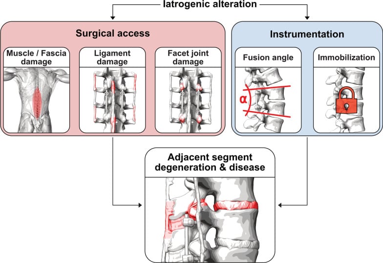 Schematic showing iatrogenic surgical and instrumentation factors that contribute to adjacent segment disease.