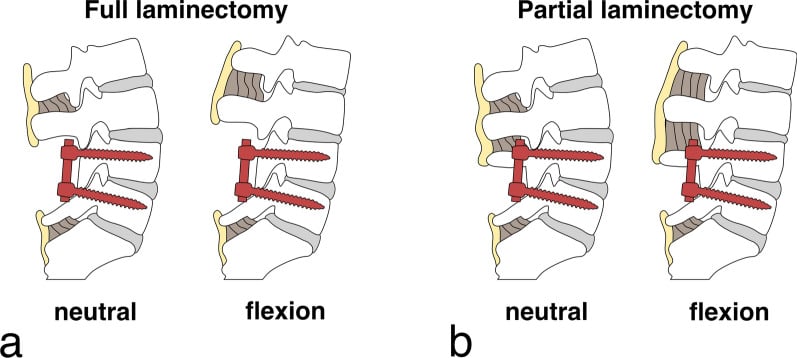 Schematic comparing full and partial laminectomy with preservation of the posterior tension band above a lumbar fusion.
