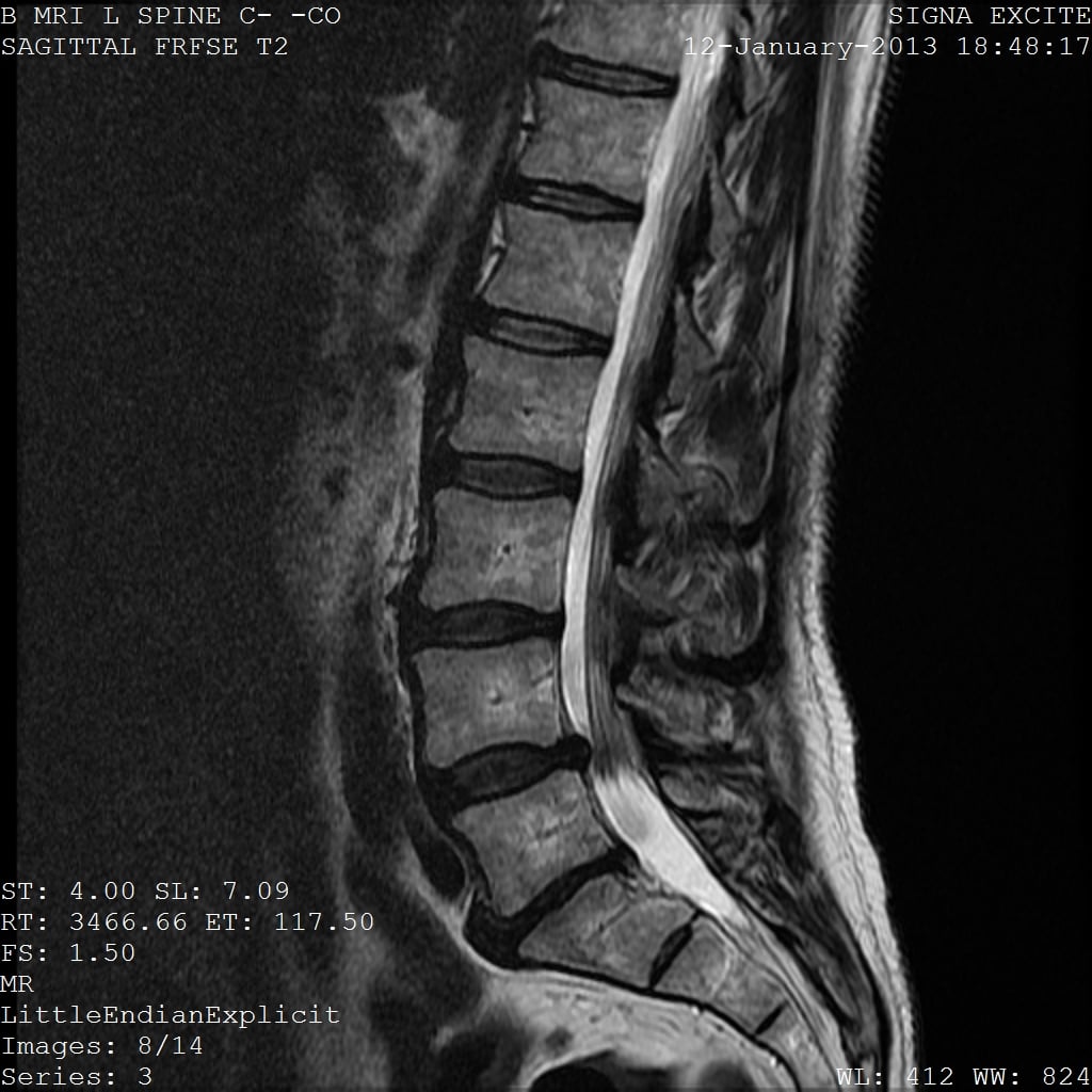 Sagittal T2 MRI of the lumbar spine showing multilevel disc degeneration.