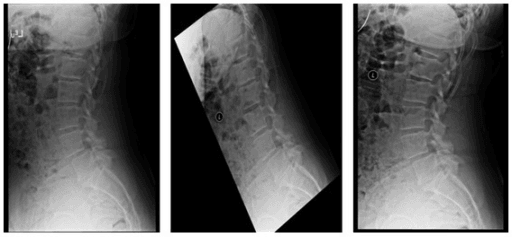 Standing, flexion and extension lumbar radiographs showing dynamic spondylolisthesis.