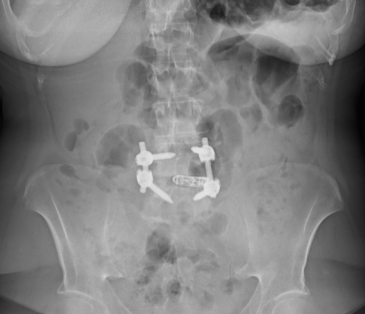 AP lumbar radiograph of a transforaminal lumbar interbody fusion with pedicle screws and an interbody cage.