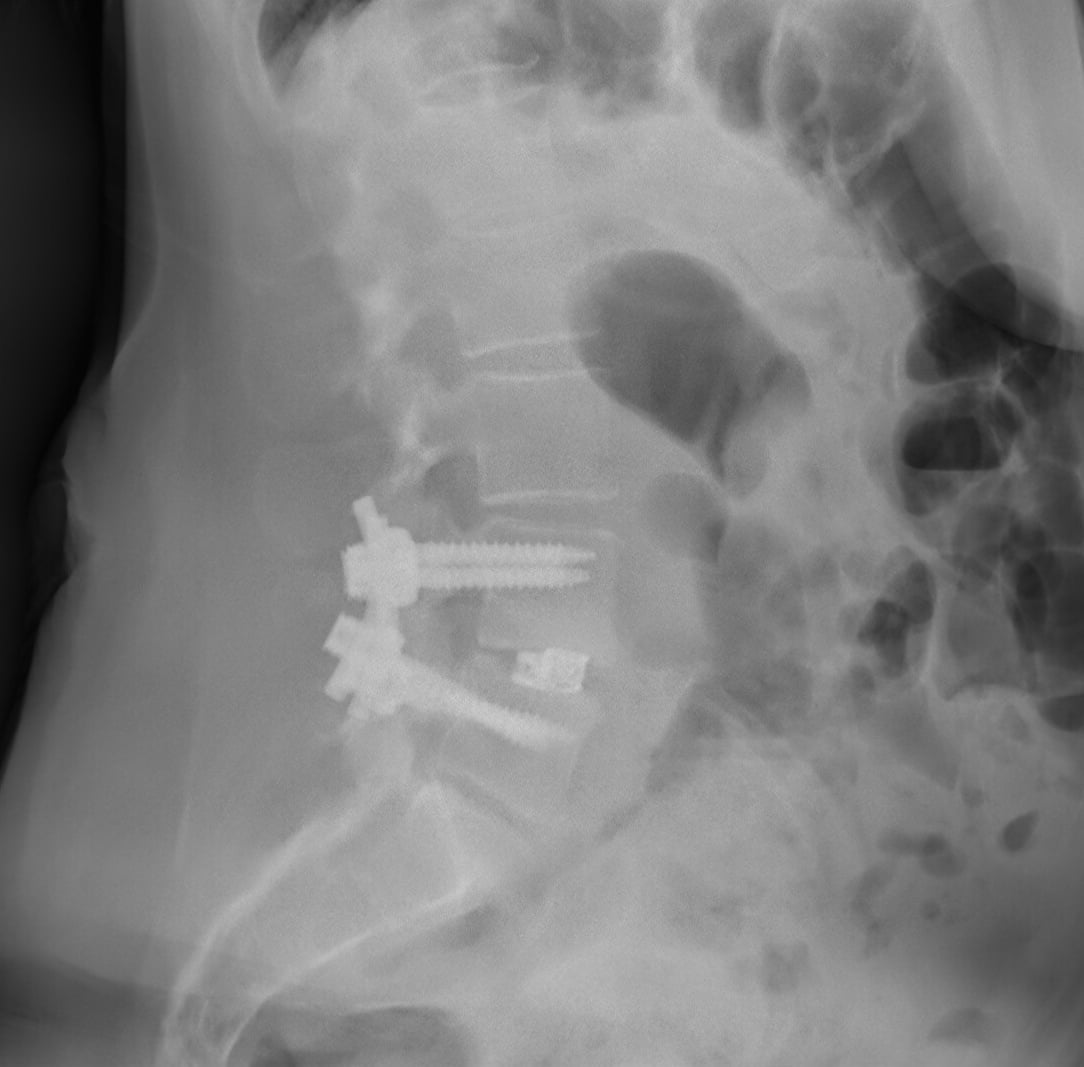 Lateral lumbar radiograph of a transforaminal lumbar interbody fusion construct.