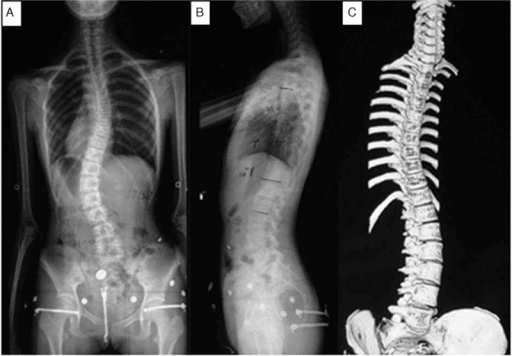 PA, lateral, and three-dimensional reconstruction views of adolescent scoliosis