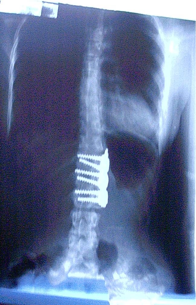 Frontal spine X-ray after anterior spinal fusion for scoliosis showing a single-rod vertebral-body screw construct