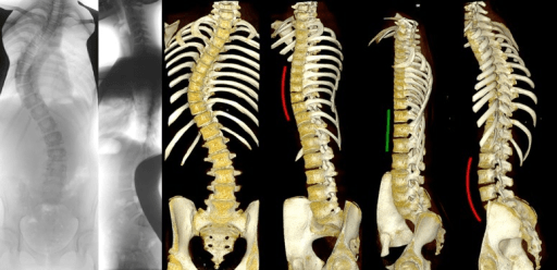 Radiographic and three-dimensional reconstruction views demonstrating scoliosis rotation
