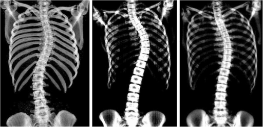 Full spine X-rays comparing supine versus standing Cobb angle measurements in scoliosis