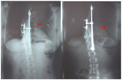 AP spine radiographs showing operative correction of an adolescent idiopathic scoliosis curve with posterior instrumentation