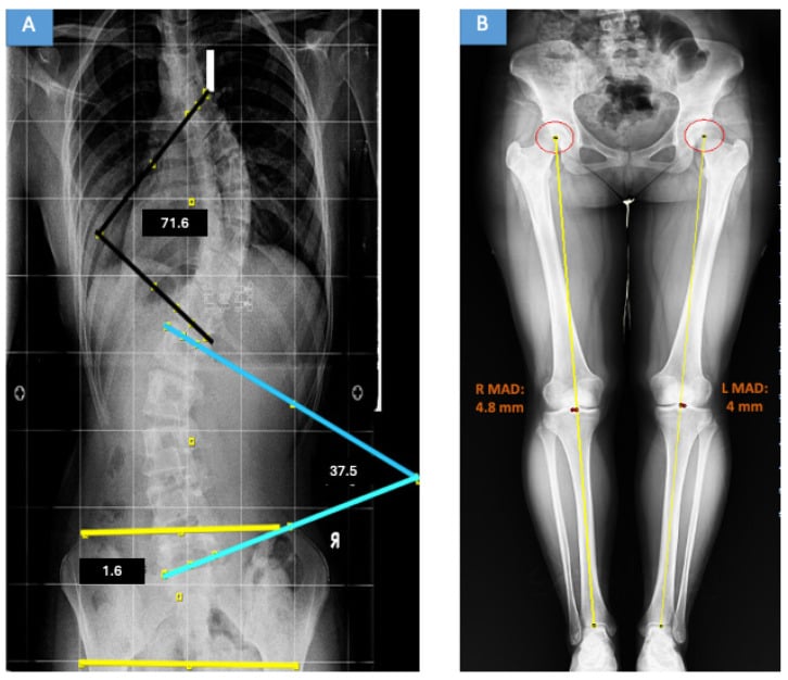 Full-length standing AP spine radiograph demonstrating Cobb angle measurement