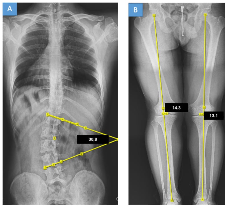 Standing full-spine radiograph showing Lenke 5C curve before and after bracing