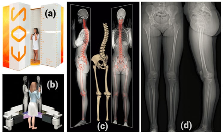 EOS 3D biplanar stereoradiography system and 3D spinal reconstruction models