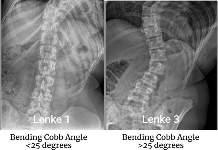 Side-bending radiographs demonstrating Lenke 1 versus Lenke 3 curve flexibility