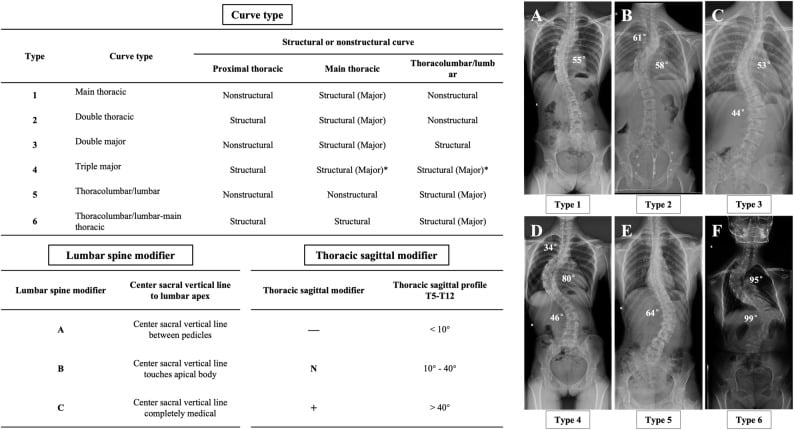 Schematic chart of the Lenke classification system for adolescent idiopathic scoliosis