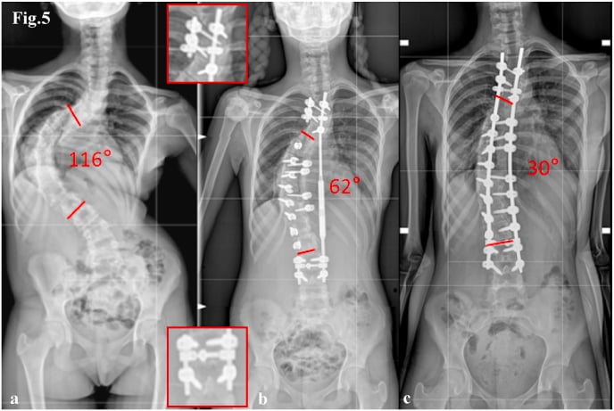 AP full-spine radiographs of Lenke 1 curve before and after T3-L4 posterior spinal fusion