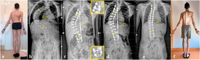 AP full-spine radiographs showing Lenke 1 curve before and after T4-L4 posterior spinal fusion