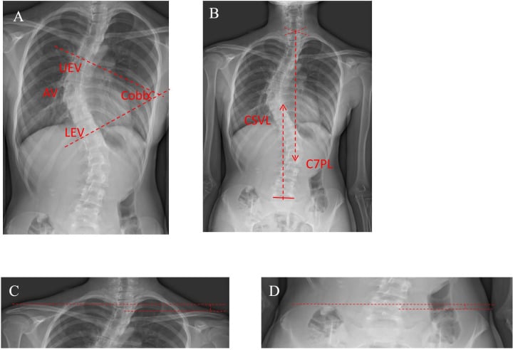 Full-spine radiographs demonstrating post-surgical add-on phenomenon and trunk decompensation