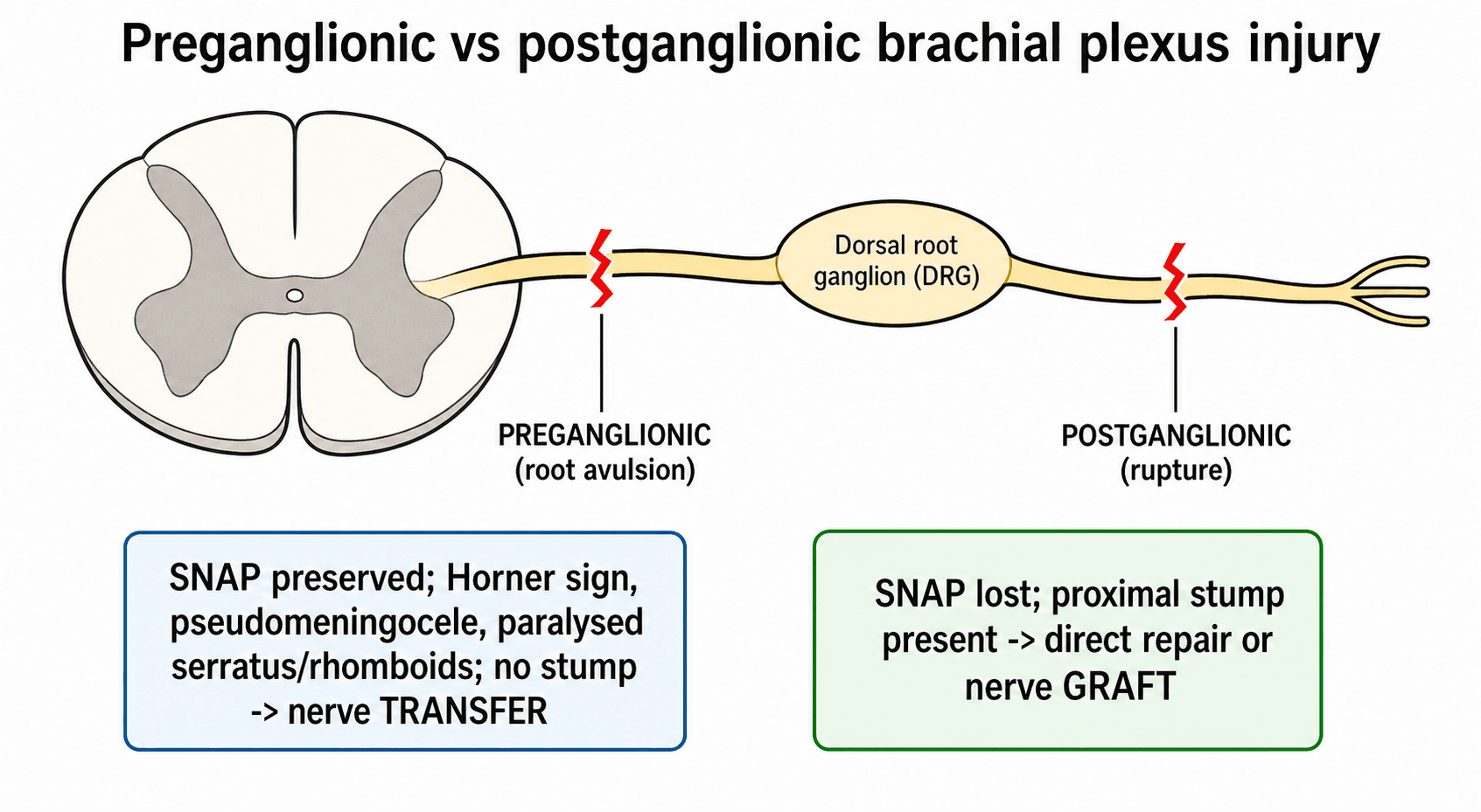 Schematic of a spinal cord, nerve root and dorsal root ganglion showing a preganglionic avulsion proximal to the DRG versus a postganglionic rupture distal to it
