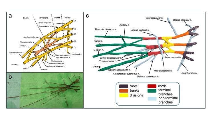 Three-panel brachial plexus anatomy figure showing a labelled conventional diagram, an isolated cadaveric plexus and a colour-coded three-dimensional model