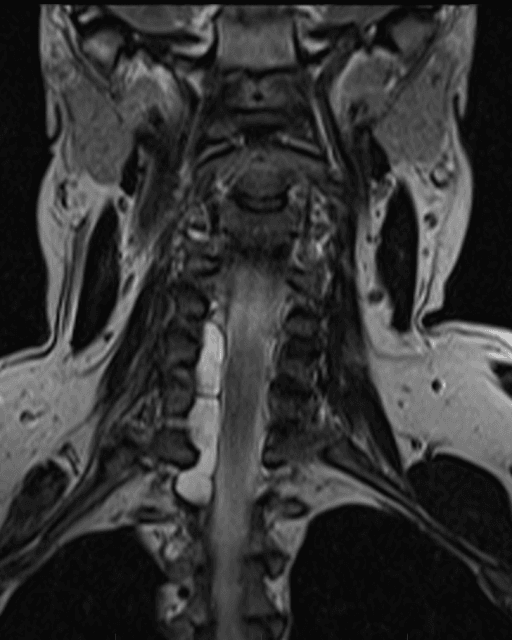 Coronal T2-weighted MRI of the cervical spine showing a CSF-bright pseudomeningocele
