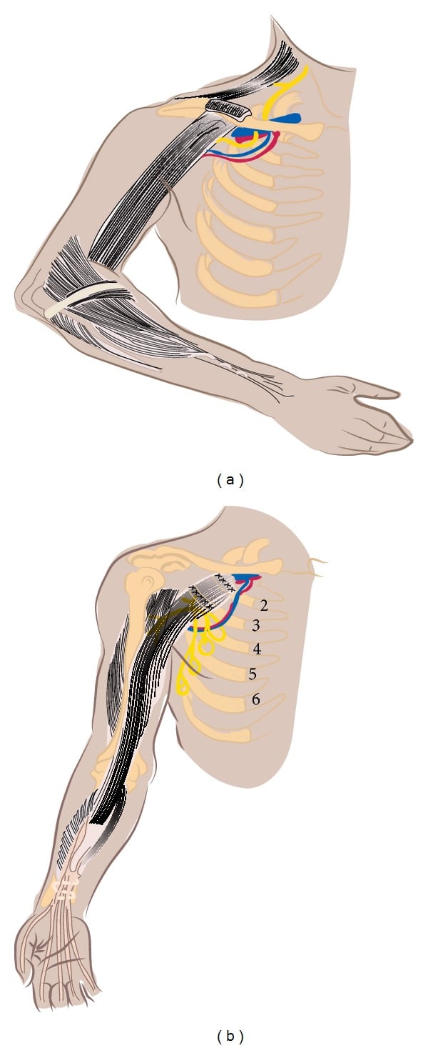Two-panel schematic of free functioning gracilis transfer for elbow flexion and double free gracilis transfer for finger extension and flexion