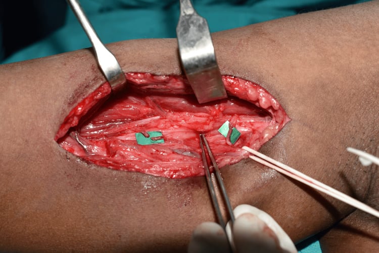 Medial arm operative photograph showing ulnar-to-biceps and median-to-brachialis fascicular coaptations