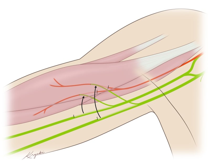 Diagram of ulnar and median donor fascicles transferred to the biceps and brachialis branches of the musculocutaneous nerve