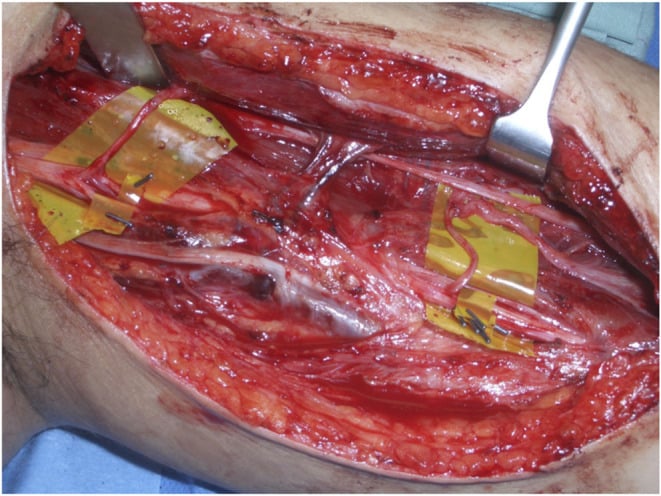 Medial arm operative field showing separated median and ulnar fascicles and musculocutaneous motor branches prepared for double fascicular transfer