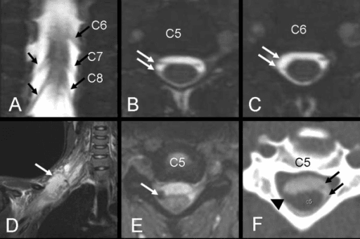 Multi-panel cervical imaging (MRI and CT) of the brachial plexus roots with arrows on nerve roots across the C5-C8 levels