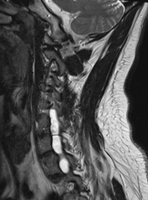 Sagittal T2-weighted MRI through the right cervical spine showing bright enlarged neural foramina at several lower cervical levels