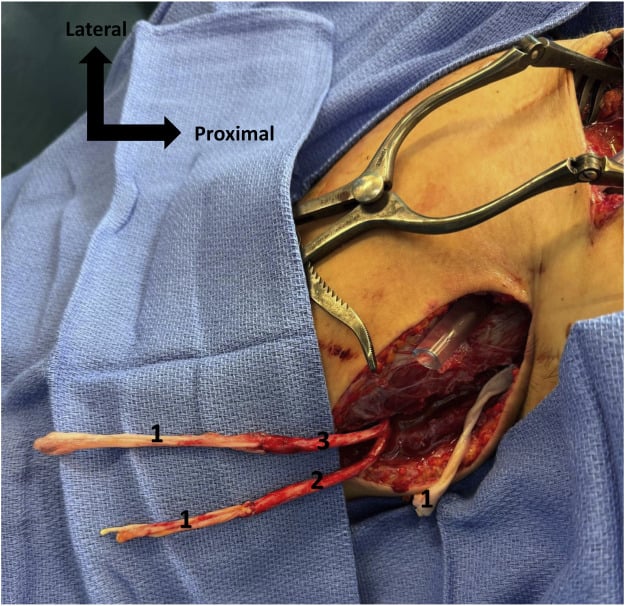 Operative supraclavicular field showing two long sural nerve grafts bridging proximal and distal brachial plexus cord stumps