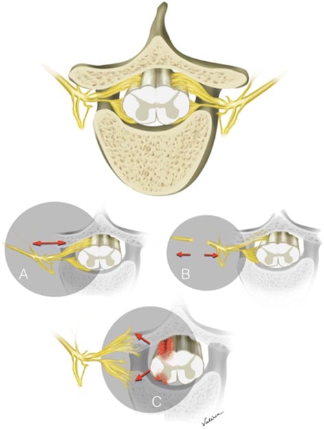 Anatomical illustration comparing stretch injury, postganglionic rupture and preganglionic root avulsion of the brachial plexus